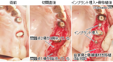 上顎、左上、臼歯部ソケットリフト＋ＧＢＲ＋インプラント傾斜埋入一次手術(インプラント埋入)