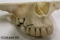 CTデータから作製した顎骨模型
