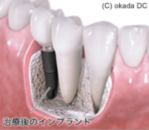 インプラントとは