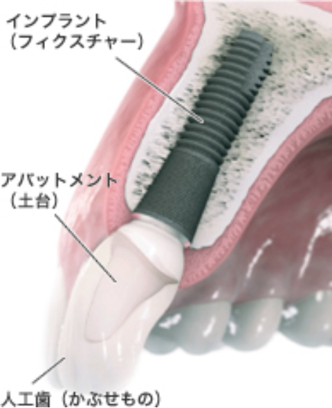 当院では、臨床データが多く、歴史あるインプラントを使用しています