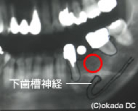 レントゲン