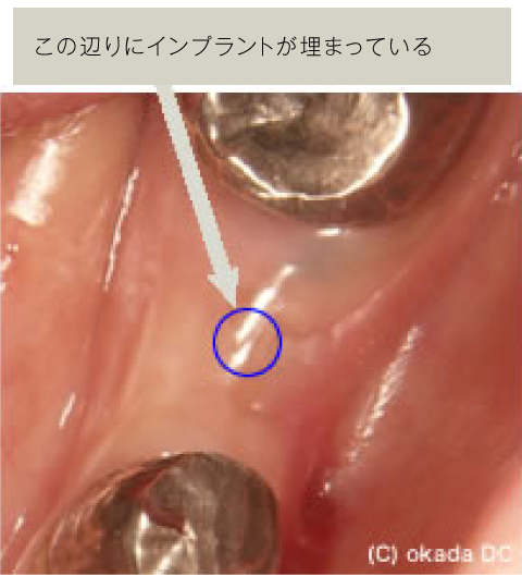 二次手術（インプラントの頭出し）