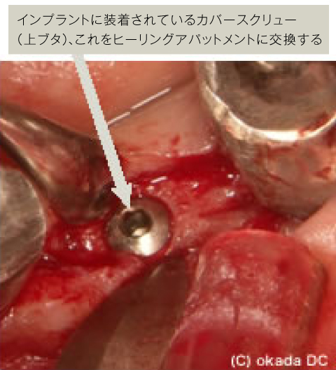 二次手術（インプラントの頭出し）