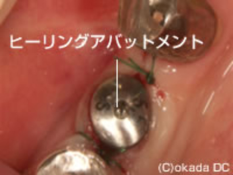 ヒーリングアバットメント