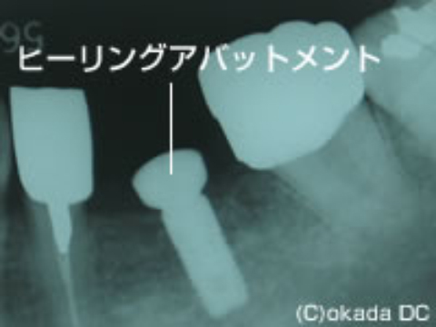 ヒーリングアバットメント