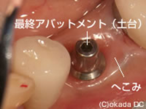 粘膜調整後
