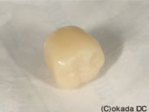 仮歯