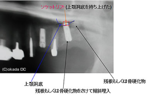 レントゲン拡大図